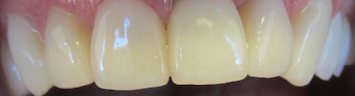 Implant-Crowns-Bleachings-After-Image