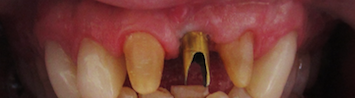 Implant-Crowns-Bleachings-Before-Image