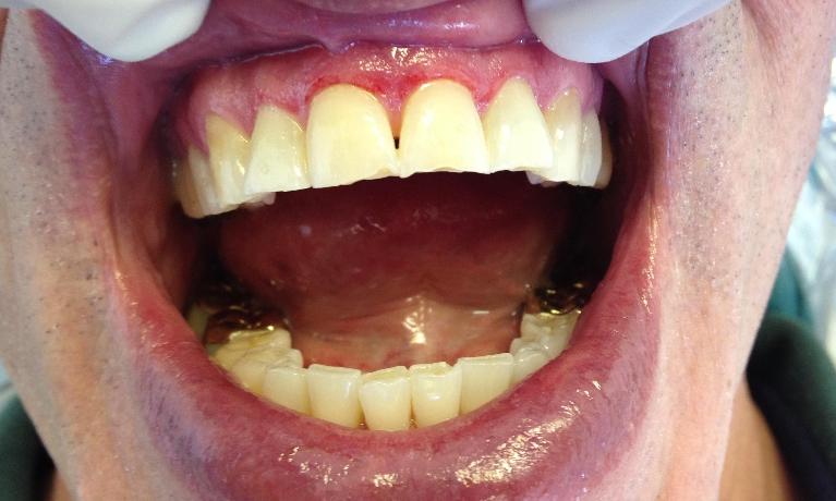 Bonding-and-Gum-Treatment-Before-Image