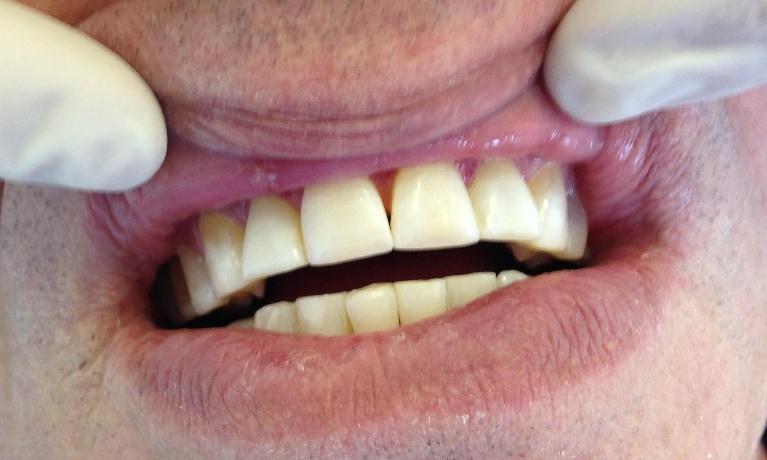 Bonding-and-Gum-Treatment-After-Image