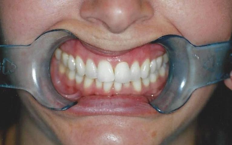 Bleaching-and-Composite-Fillings-After-Image
