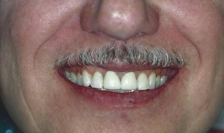 Crowns-and-Bonding-After-Image