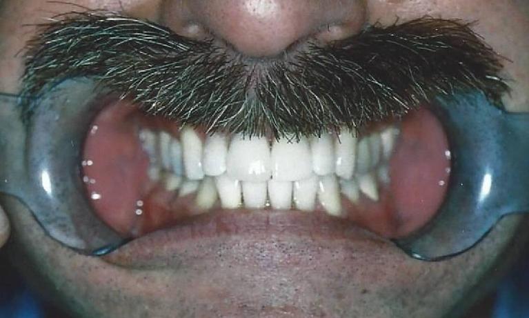 Porcelain-Crowns-After-Image