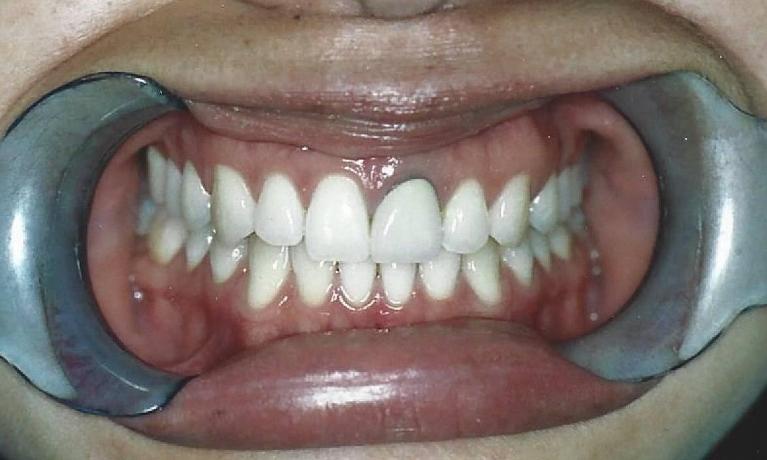 Porcelain-Crowns-Before-Image