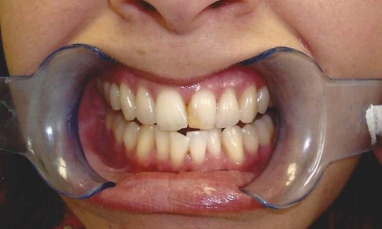 Bleaching-and-Composite-Fillings-Before-Image