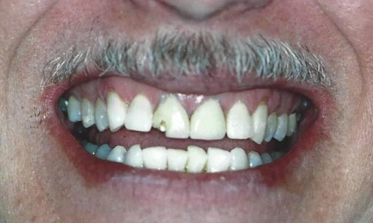 Crowns-and-Bonding-Before-Image