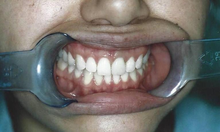 Porcelain-Crowns-After-Image