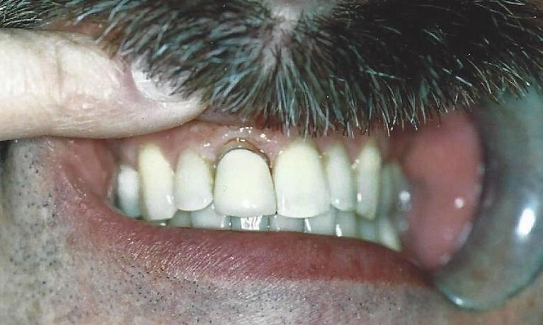 Porcelain-Crowns-Before-Image